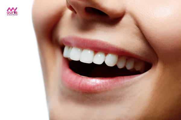 Lợi ích của niềng răng thưa xóa bỏ khoảng cách hở răng, đem đến vẻ đẹp thẩm mỹ 