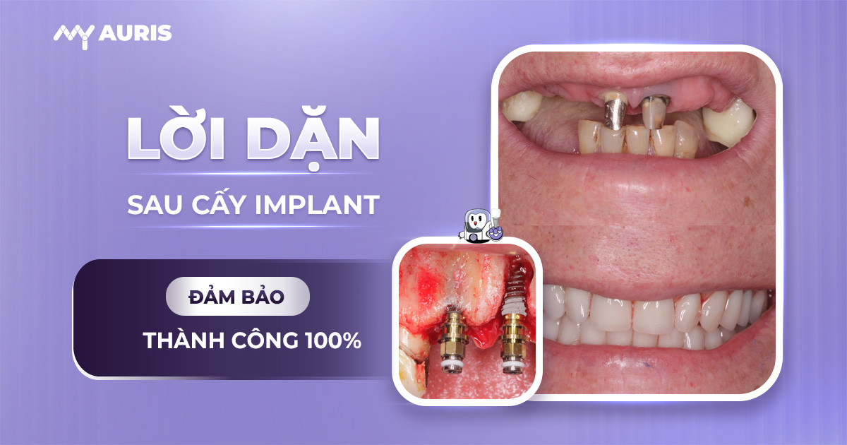 lời dặn sau cấy implant,lời dặn sau cắm implant