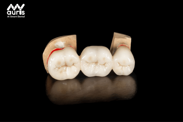 Cầu răng sứ hỗ trợ phục hình răng mất