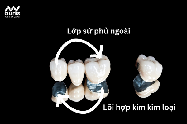 Ưu và nhược điểm của răng sứ kim loại 