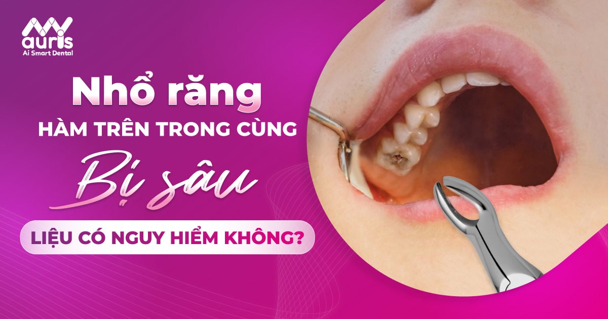 Nhổ răng hàm trên trong cùng bị sâu