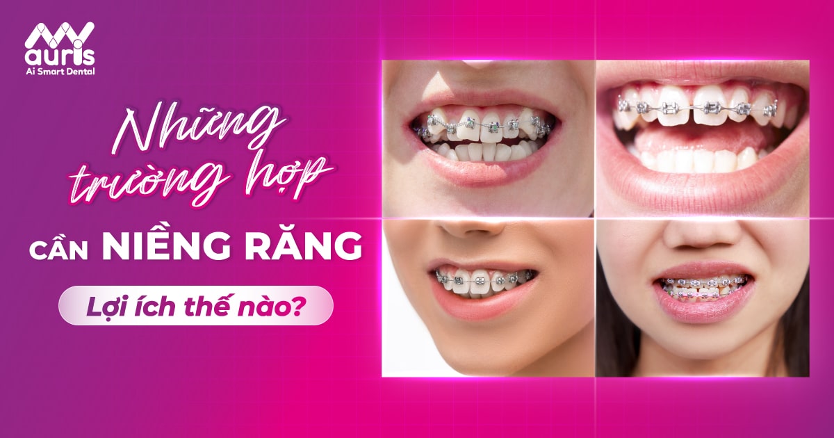 Những trường hợp cần niềng răng