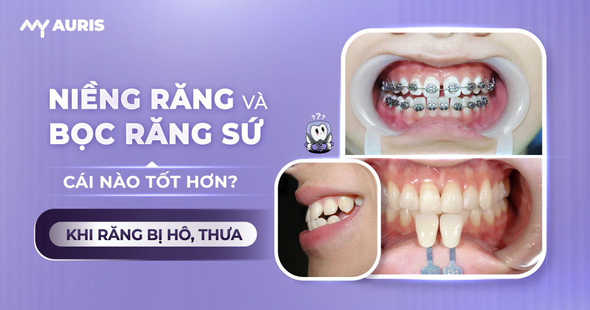 niềng răng và bọc răng sứ cái nào tốt hơn