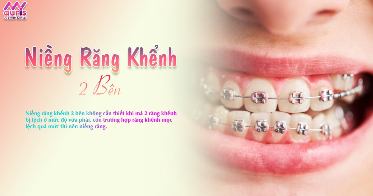 niềng răng khểnh 2 bên