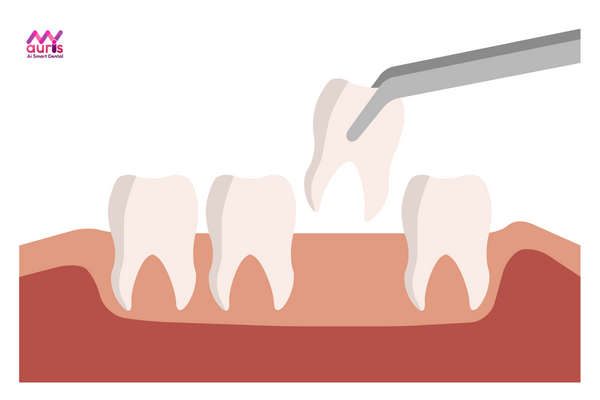 Niềng răng khểnh thường nhổ răng nào? 