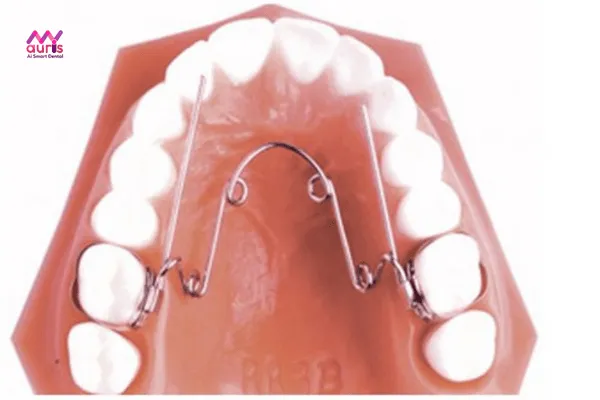 Áp dụng nong hàm giúp bảo tồn răng gốc khi niềng răng 
