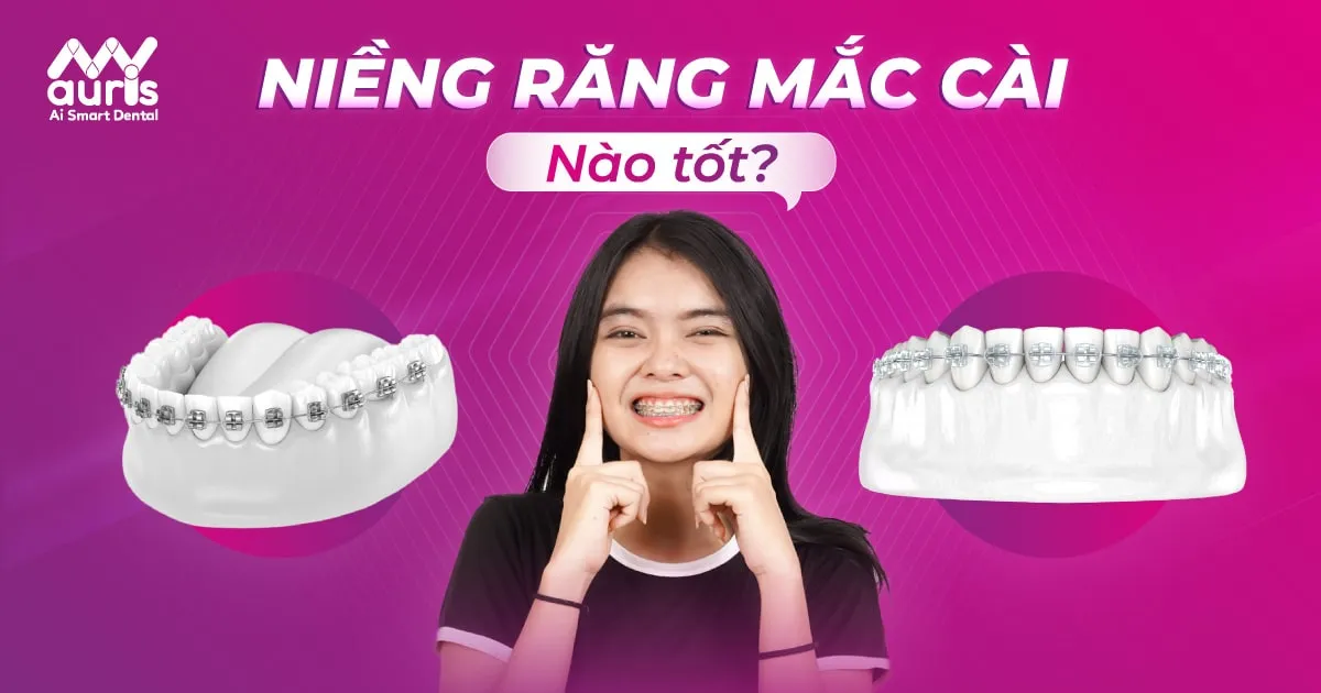 Niềng răng mắc cài nào tốt và 2 kỹ thuật phổ biến?