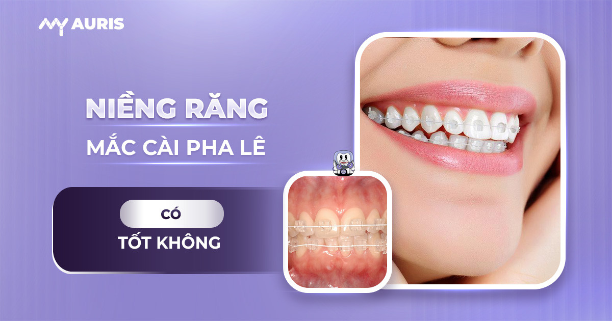 niềng răng mắc cài pha lê,có nên niềng răng mắc cài pha lê không,niềng răng mắc cài pha lê có tốt không