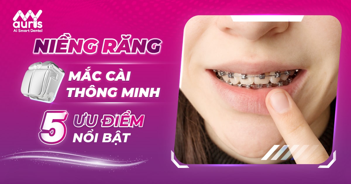 Niềng răng mắc cài thông minh với 5 ưu điểm nổi bật