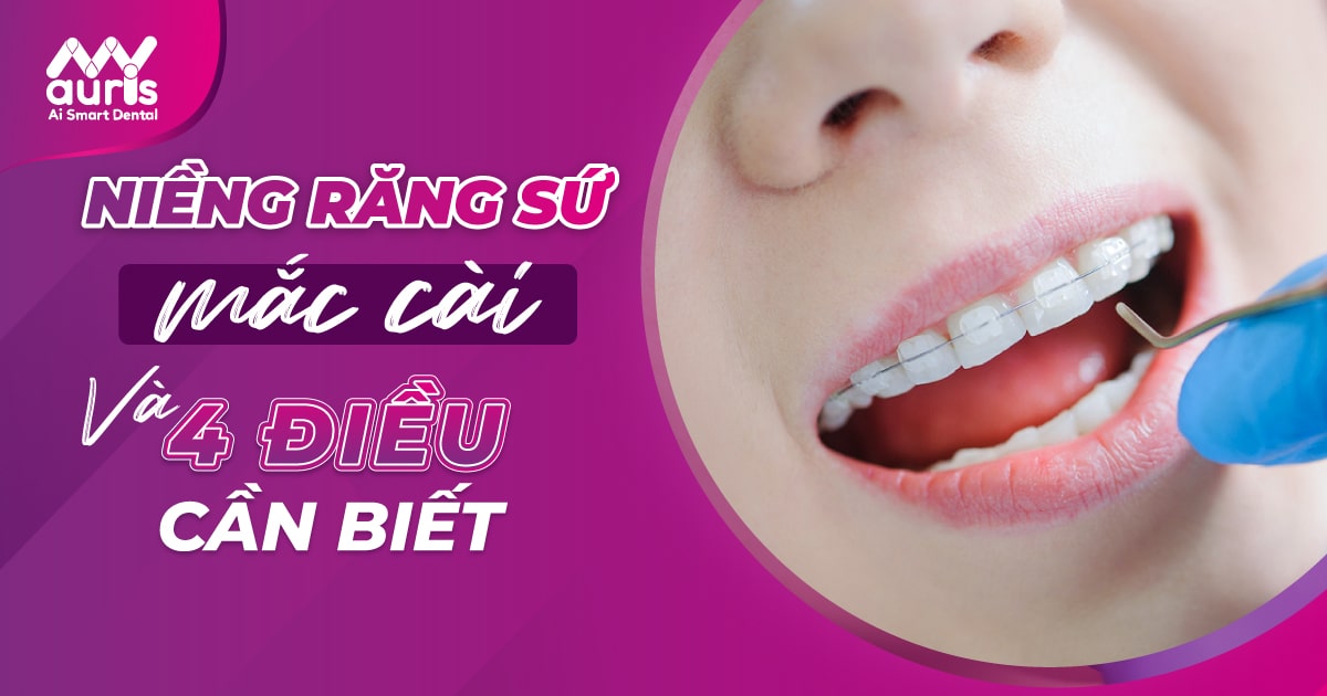 niềng răng sứ mắc cài