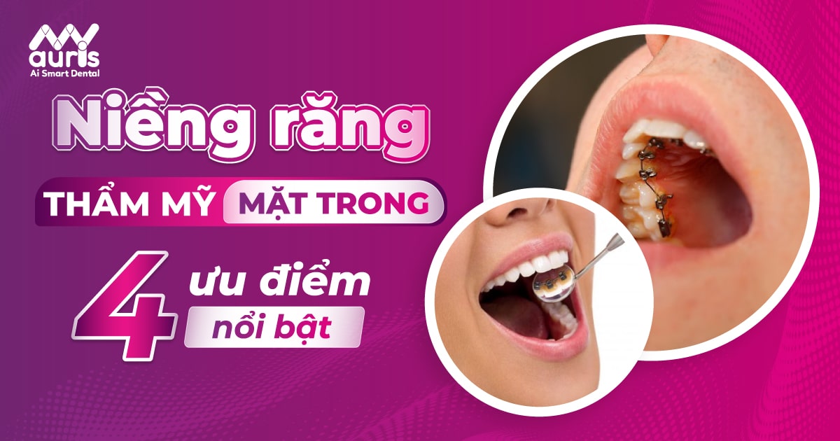 Niềng răng thẩm mỹ mặt trong với 4 ưu điểm nổi bật