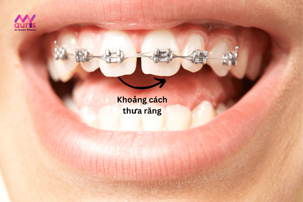Niềng răng thưa bao lâu còn phụ thuộc mức độ, trường hợp thưa nhẹ sẽ rút ngắn hơn tình trạng nặng 