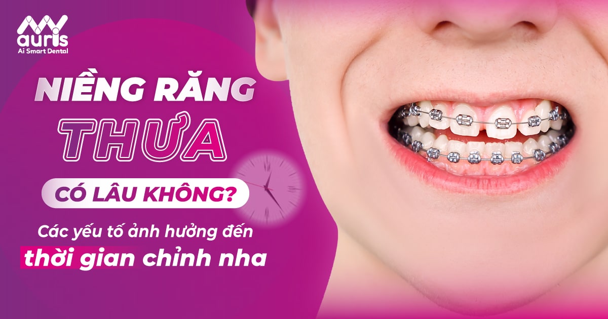 Niềng răng thưa có lâu không?