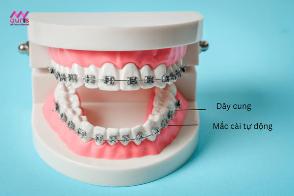 Niềng răng mắc cài kim loại/ sứ tự động 