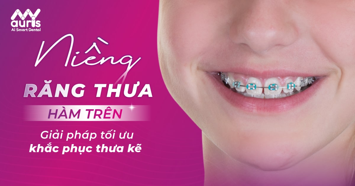 Niềng răng thưa hàm trên