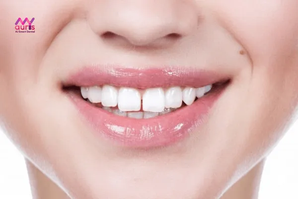 Đặc điểm của răng thưa nhẹ 