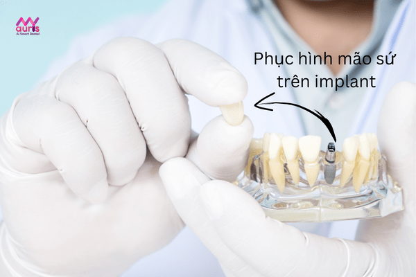 Kỹ thuật phục hình răng sứ trên implant 
