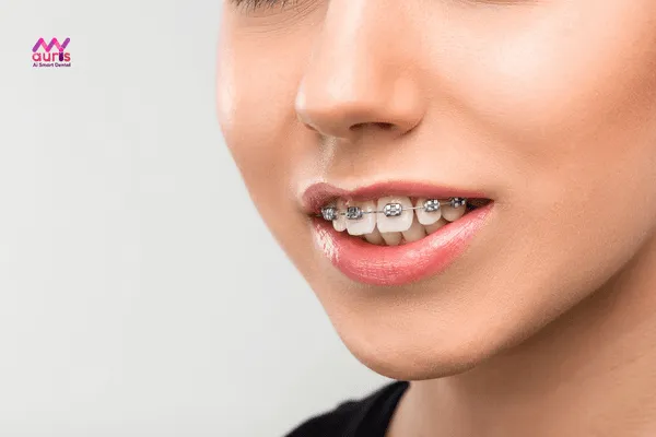 Khi nào quá trình niềng răng hô nhổ răng? 