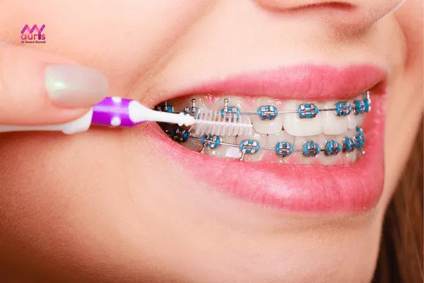 Vệ sinh răng miệng trong quá trình niềng răng để bảo vệ sức khỏe răng miệng tốt hơn 