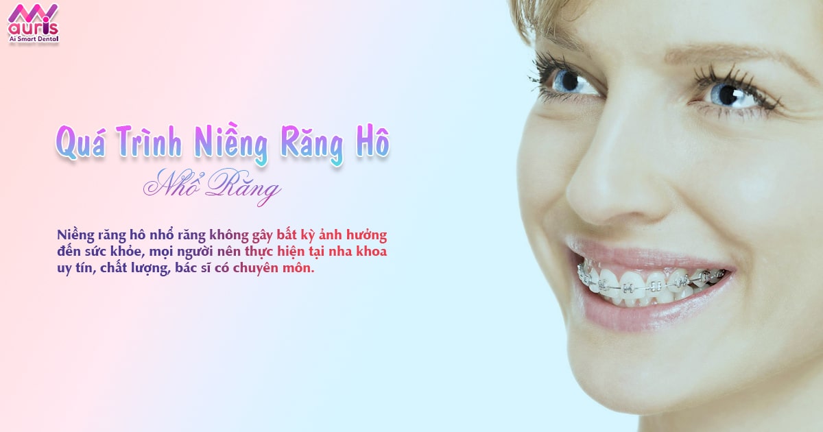 quá trình niềng răng hô nhổ răng