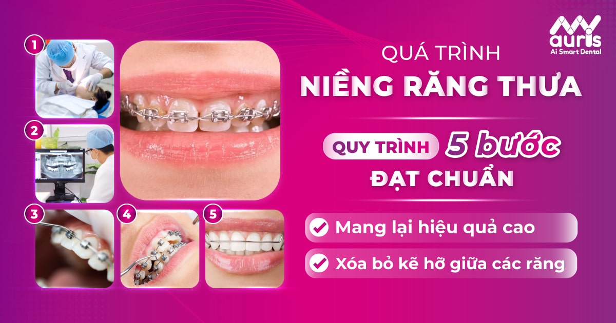 Quá trình niềng răng thưa