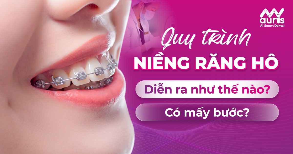 quy trình niềng răng hô