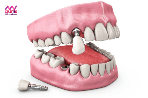 Làm răng sứ trên Implant có đổi mới được không?