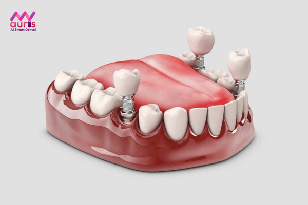 Tiến trình làm răng sứ Implant tại nha khoa hiện nay