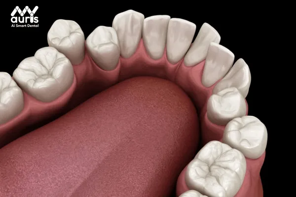 Nguyên nhân gây ra tình trạng răng khấp khểnh hàm dưới?