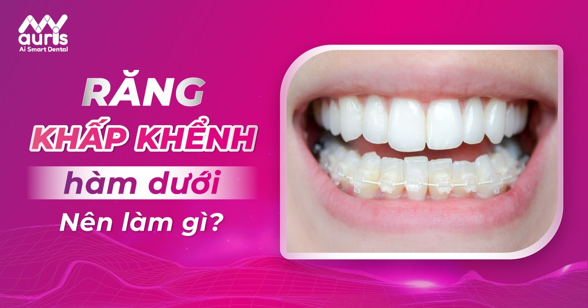 Răng khấp khểnh hàm dưới nên làm gì? Niềng hay bọc sứ?