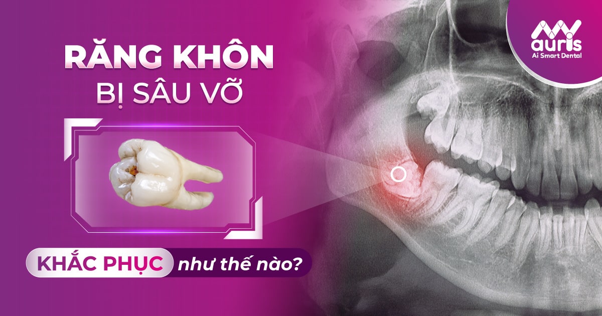 Răng khôn bị sâu vỡ