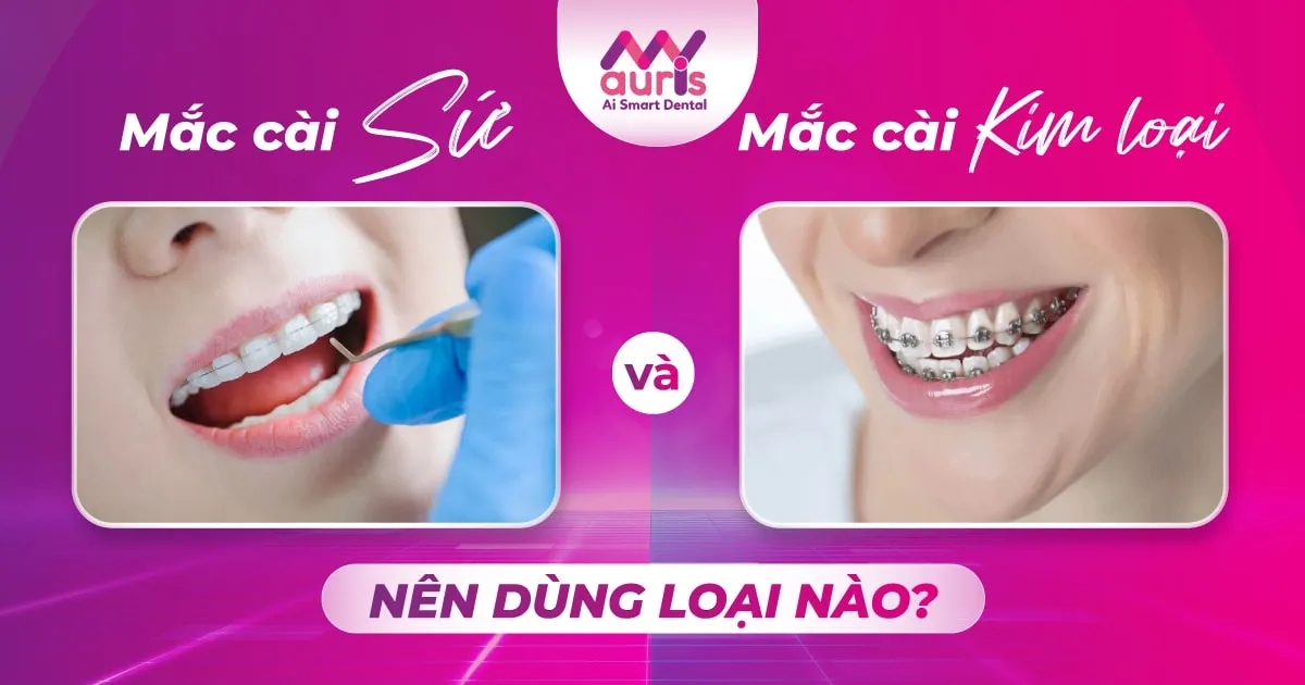 Hỏi đáp bác sĩ nên niềng răng mắc cài sứ hay kim loại?