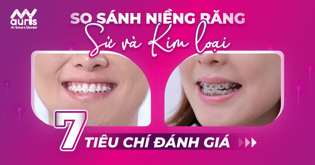 So sánh niềng răng sứ và kim loại