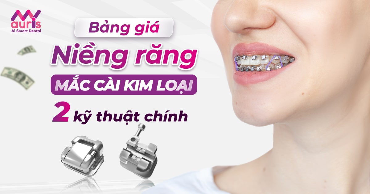 Bảng giá niềng răng mắc cài kim loại: 2 kỹ thuật chính