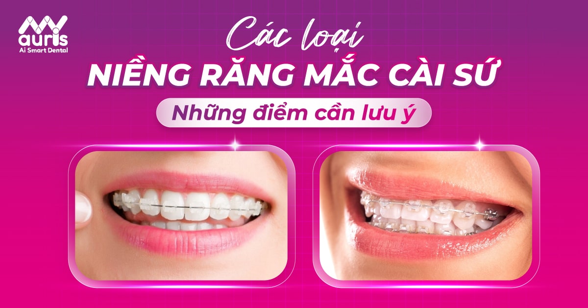 Các loại niềng răng mắc cài sứ và điểm cần lưu ý