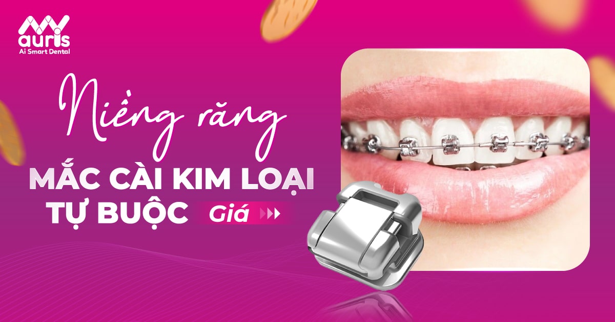 Giá niềng răng mắc cài kim loại tự buộc (Hỏi đáp bác sĩ)