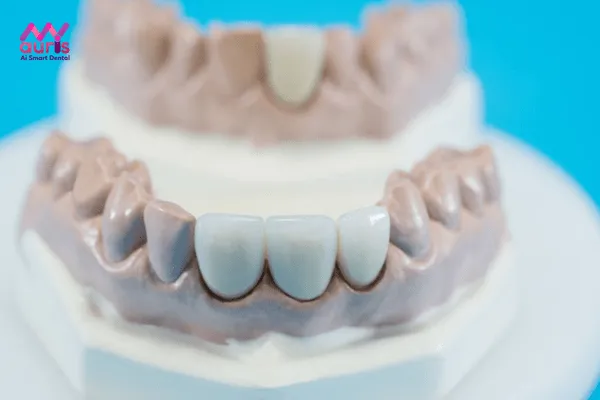 Tại sao lại có tên gọi là các loại răng sứ không kim loại?