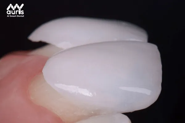 Có nên thực hiện bọc răng sứ không kim loại không?