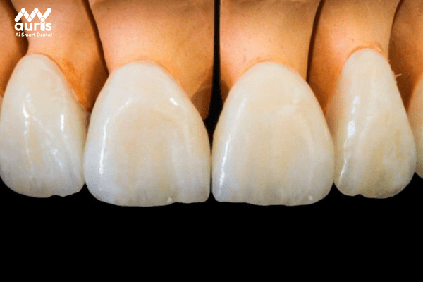Răng sứ kim loại quý Au-Pd