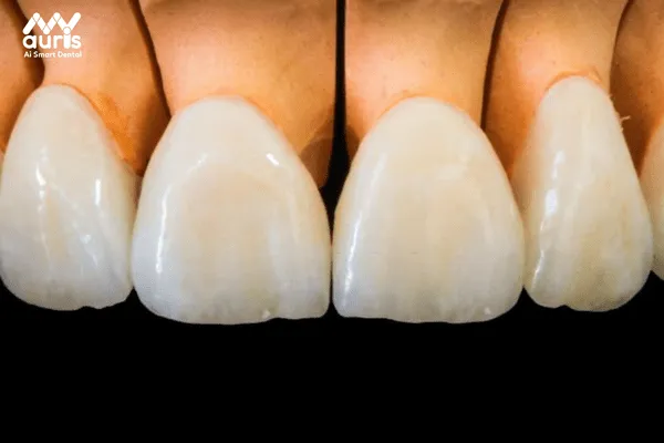 Răng sứ kim loại quý Au-Pd