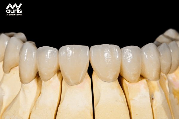 Các loại răng sứ cao cấp hiện nay - Răng sứ Diamond