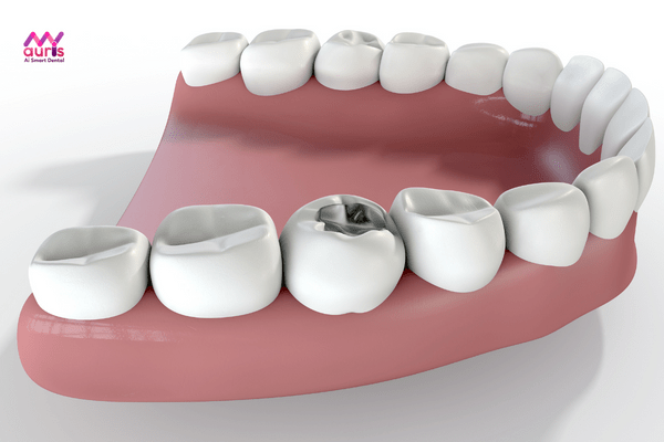 Răng sâu nhẹ, lỗ nhỏ có thể trám răng thẩm mỹ để bảo vệ răng miệng 