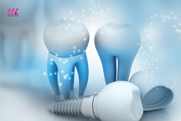 Kỹ thuật trồng răng công nghệ implant 3d sophis 