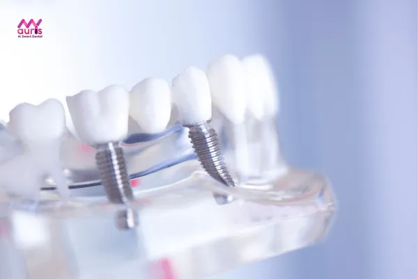 Vì sao nên chọn trồng răng công nghệ implant 3d sophis?