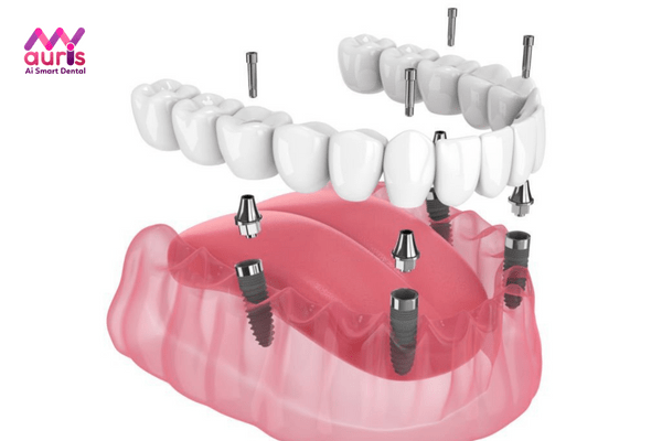 Phục hình răng giả bằng cấy ghép Implant