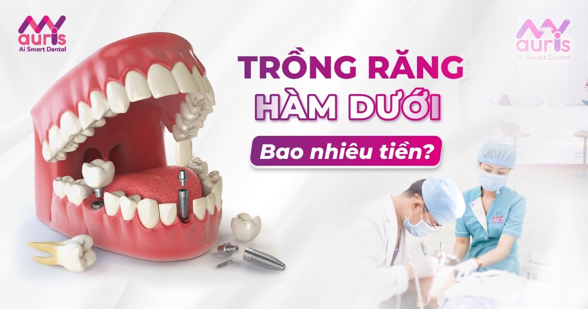 Trồng răng hàm dưới bao nhiêu tiền và bằng cách nào?