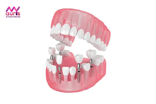 Trồng răng Implant bao nhiêu tiền cho răng đơn lẻ?