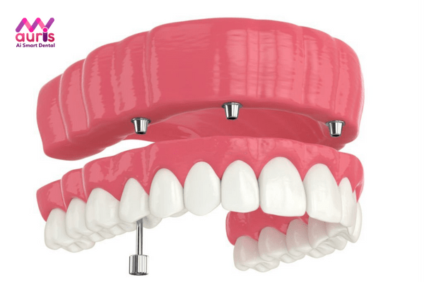 Trồng răng Implant cho toàn hàm