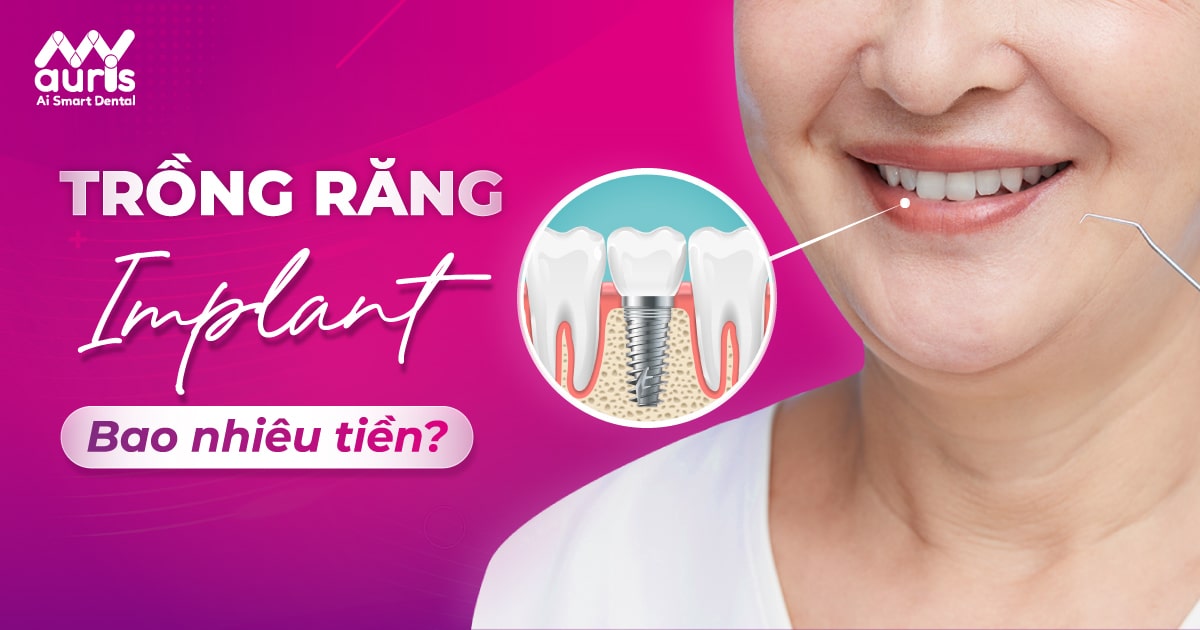 Trồng răng Implant bao nhiêu tiền và 2 chi phí liên quan