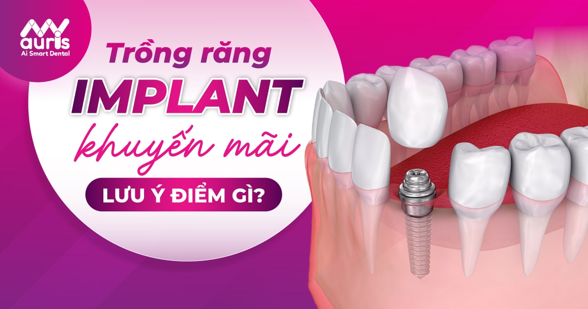 Trồng răng Implant khuyến mãi và 3 điểm cần lưu ý